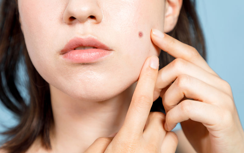 ニキビにヒドロコルチゾンクリームを使用する方法