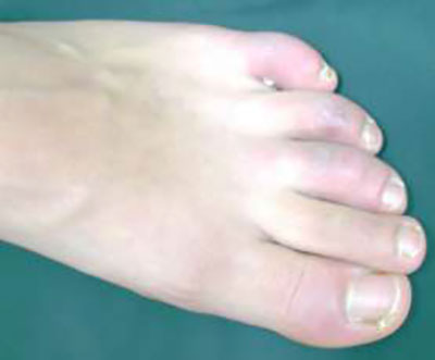 足の親指の腫れ