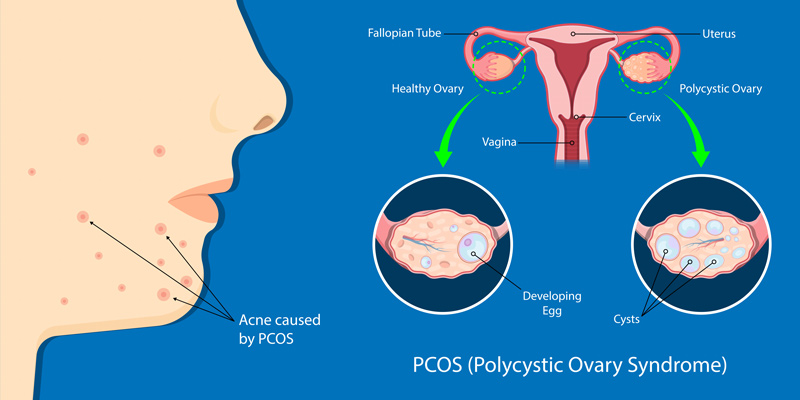 Pcos 性 卵巣 症候群 多 嚢胞