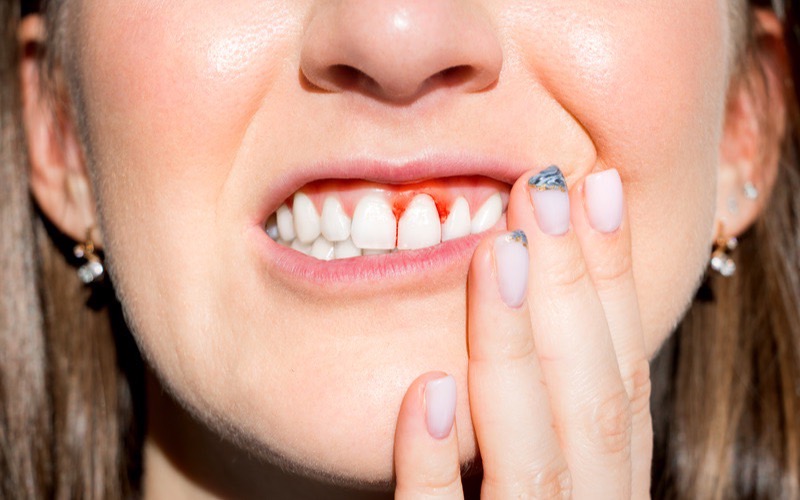 歯周病の女性イメージ