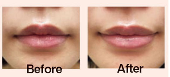 リップ before after
