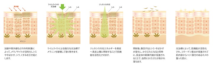 恐る恐る美容医療体験 シミ取りライムライト ジェネシスで肌は変わる Oggi Jp